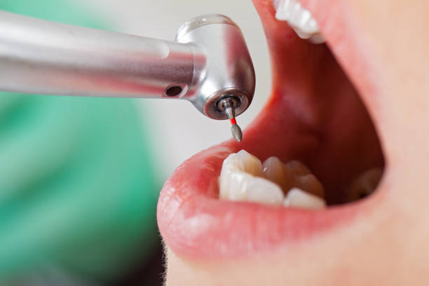 Best Emergency Wisdom Tooth Extraction in Mianna, AR